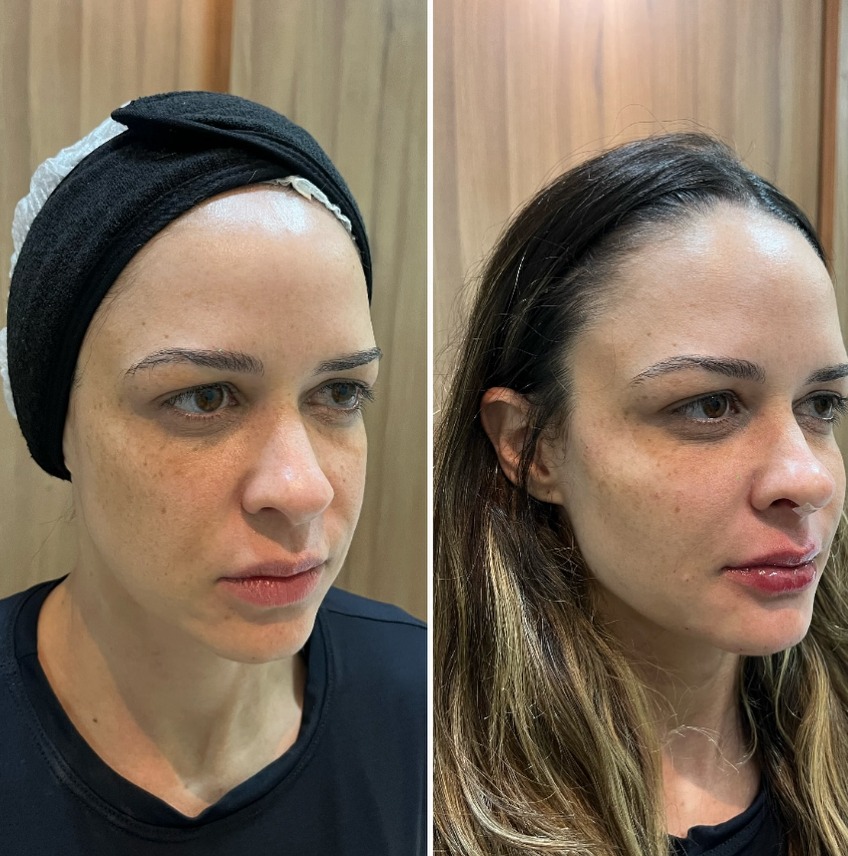 Rinoplastia e Preenchimento Labial